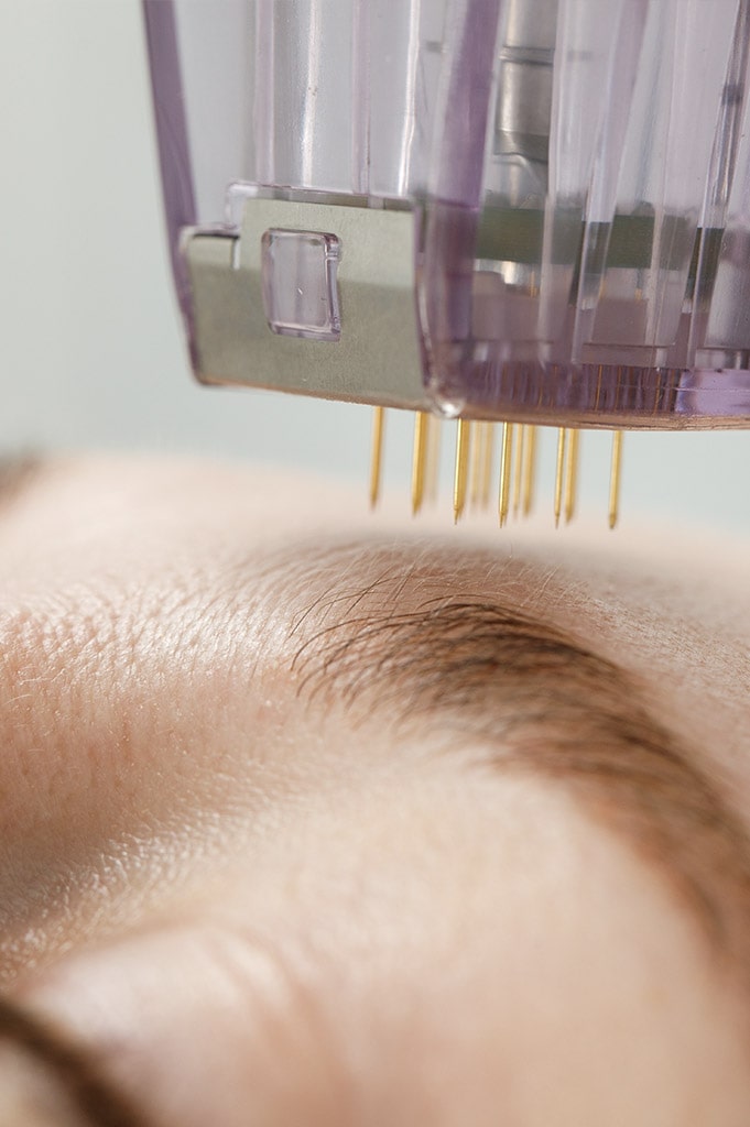 RF microneedling