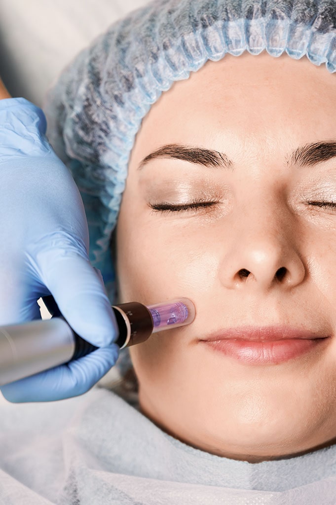 Skinpen microneedling