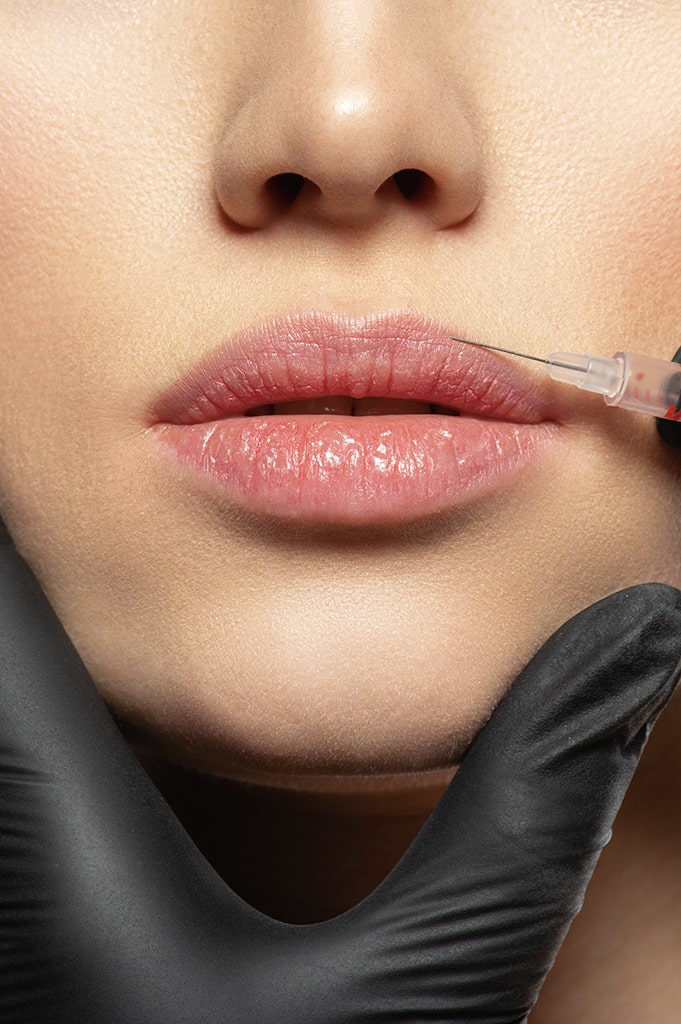 lip fillers