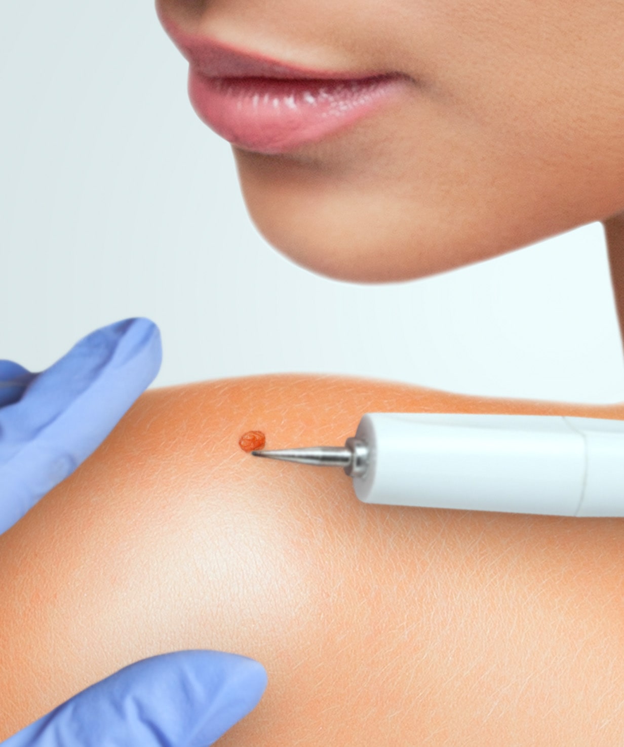 warts removal banner