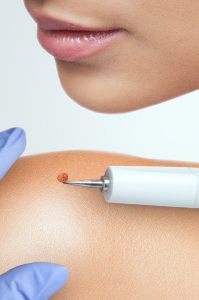 warts removal